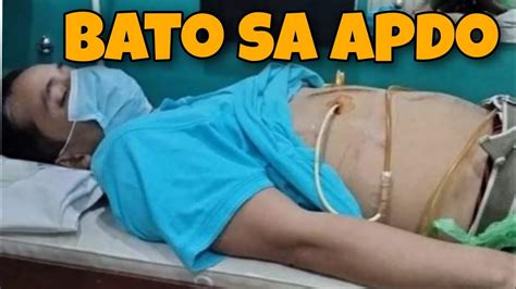 magkano ang operasyon sa bato sa apdo|Bato sa Daluyan ng Apdo (Choledocholithiasis).